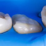 caries restoration 1
