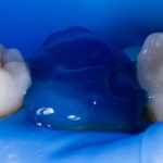 caries restoration 2