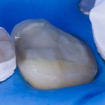 caries restoration 3