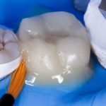 caries restoration 5