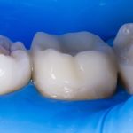 caries restoration 6