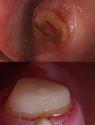 Clinical Case Dr. Francisco Monzo