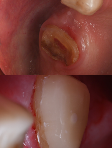 Rehabilitación del sector posterior con endodoncia y build-up.