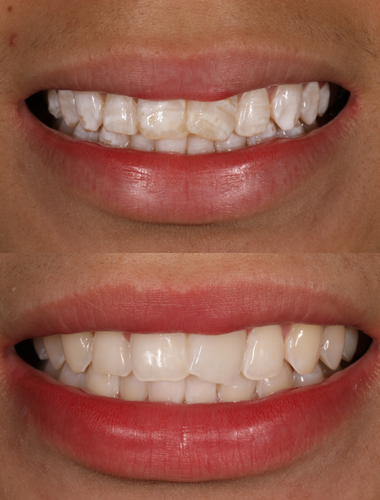 Caso clinico de Fluorosis dental. Antes y Después.