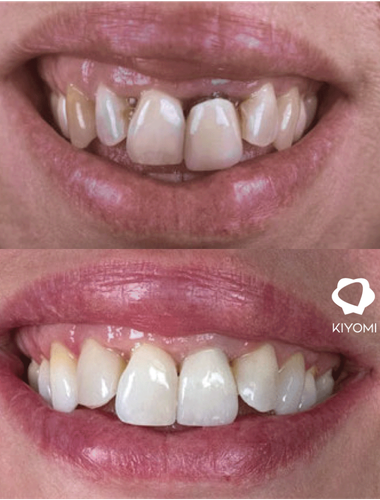 Blanqueamiento dental