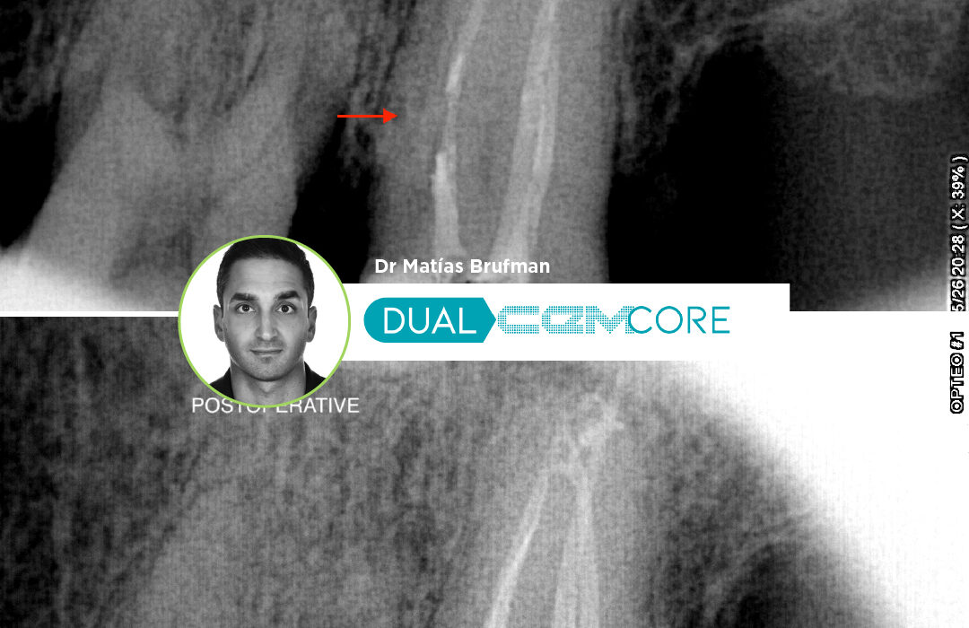 Caso Clínico Dr. Matías Brufman con cemento Dual Cem Core de Kiyomi