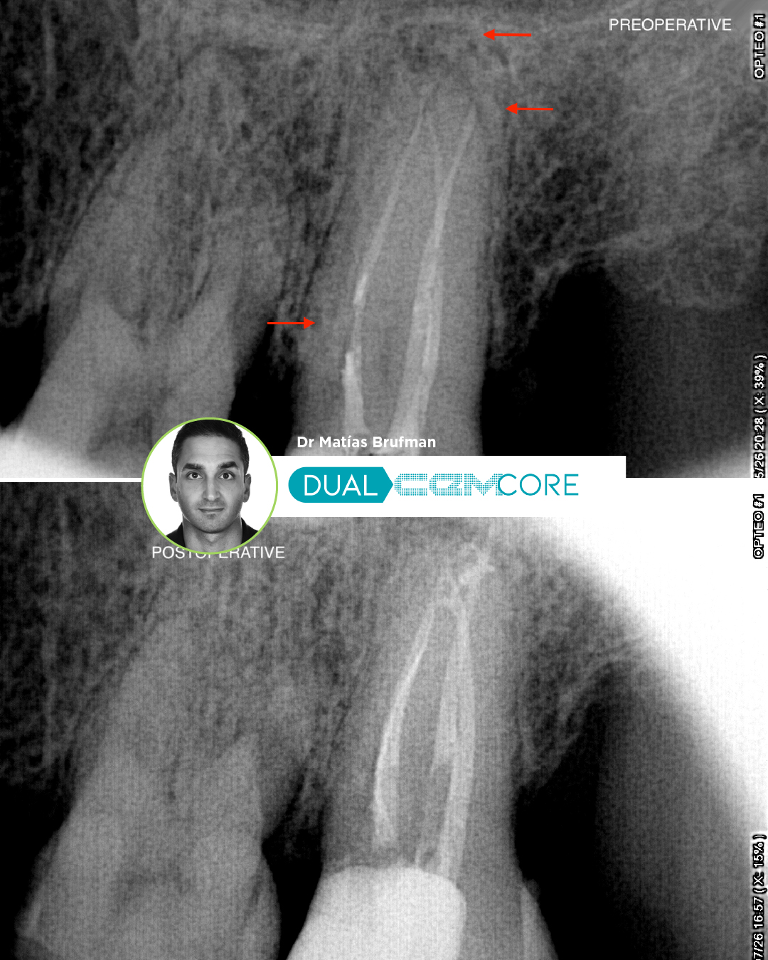Caso Clínico Dr. Matías Brufman con cemento Dual Cem Core de Kiyomi
